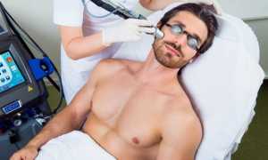 Эпиляция бороды у мужчин: способы удаления