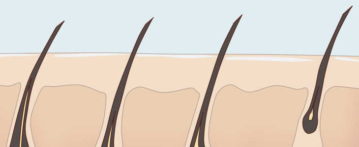 Волосы после шугаринга: сколько не растут и через сколько процедур перестают расти