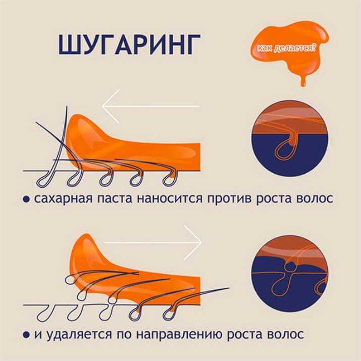 Эпиляция или депиляция в чем разница картинки