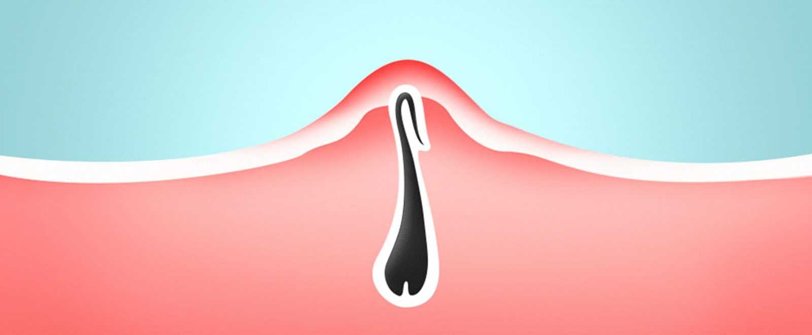Лазерное удаление волос: как работает, как делается эпиляция и на сколько эффективна