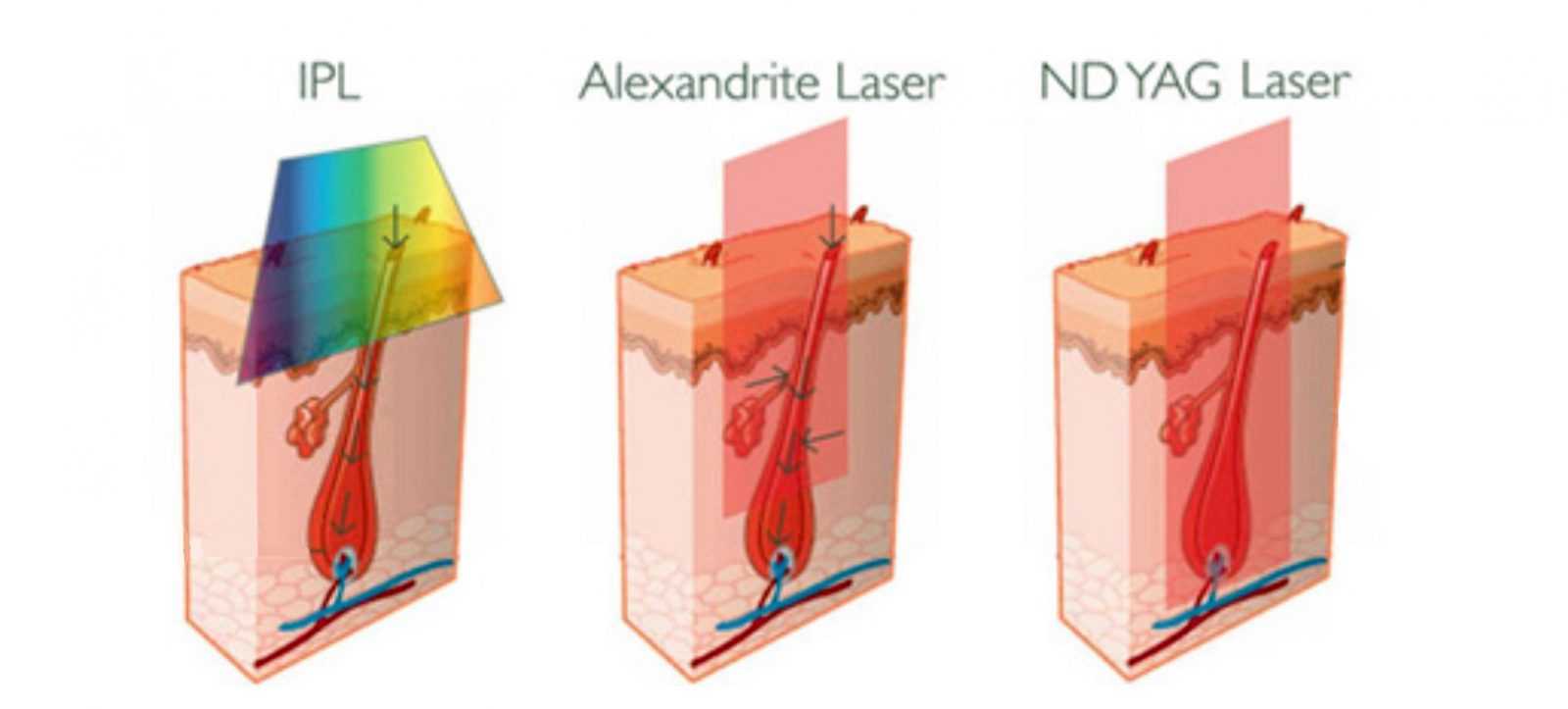 Какой лазер лучше и эффективнее для удаления волос с тела