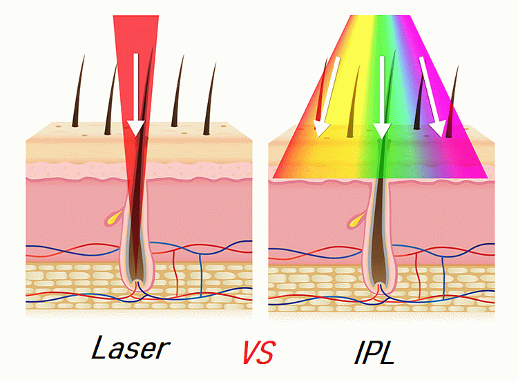 Какой лазер лучше и эффективнее для удаления волос с тела