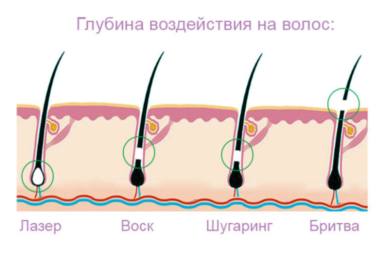 Схема удаления волос в зоне бикини