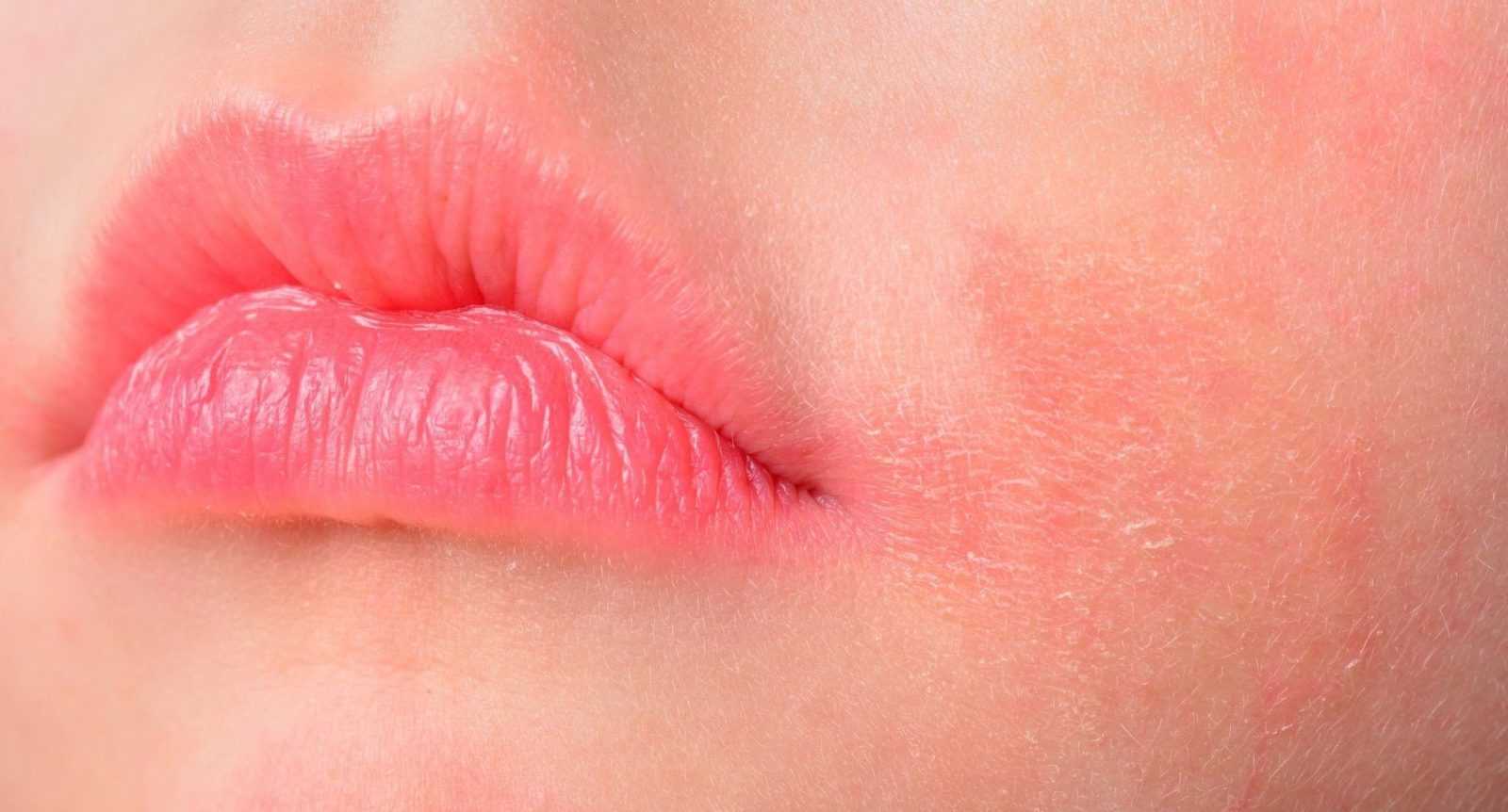 Лазерная эпиляция волос над верхней губой: преимущества и недостатки