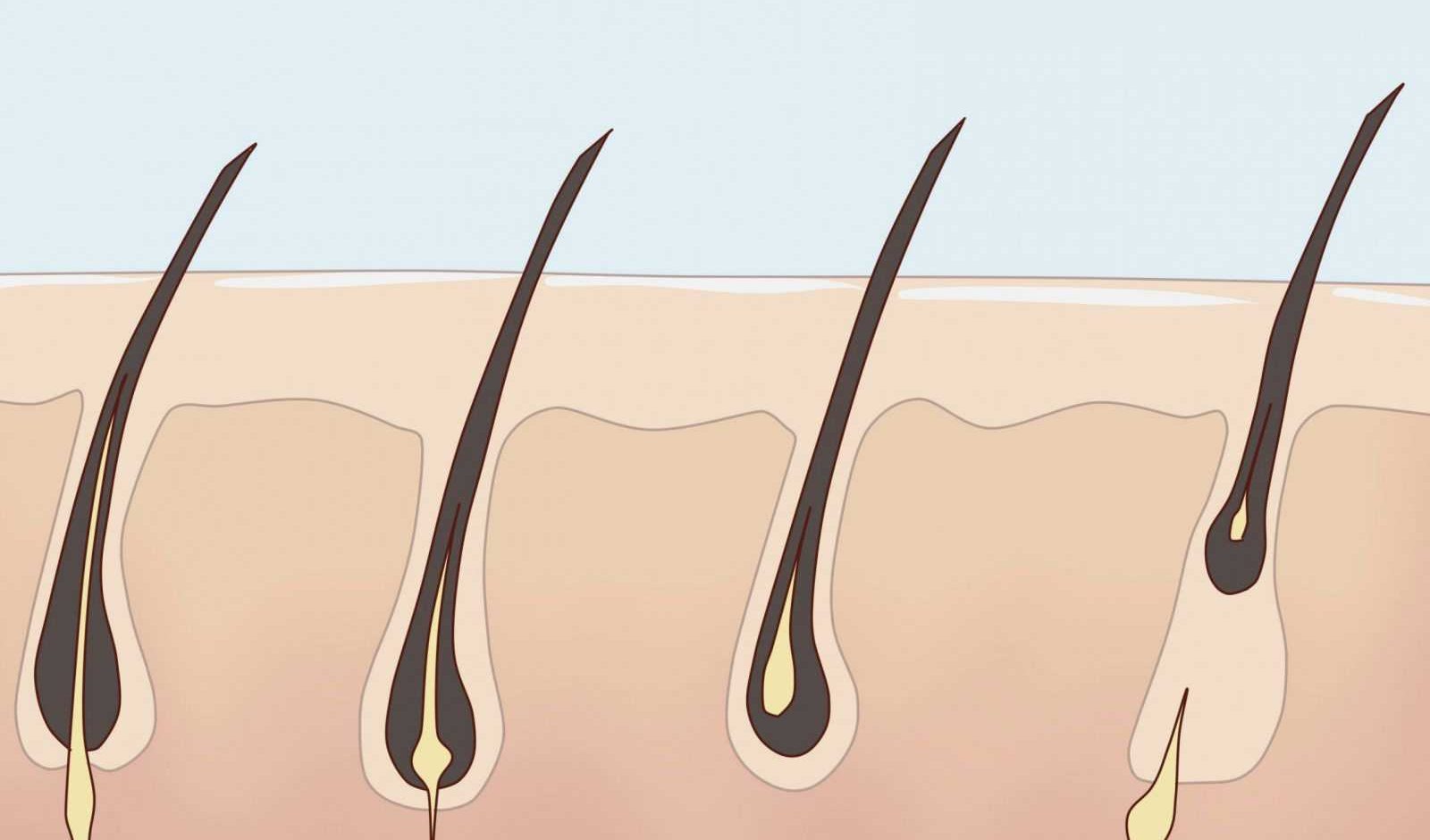 Особенности лазерной эпиляции: когда начинают выпадать волосы после процедуры